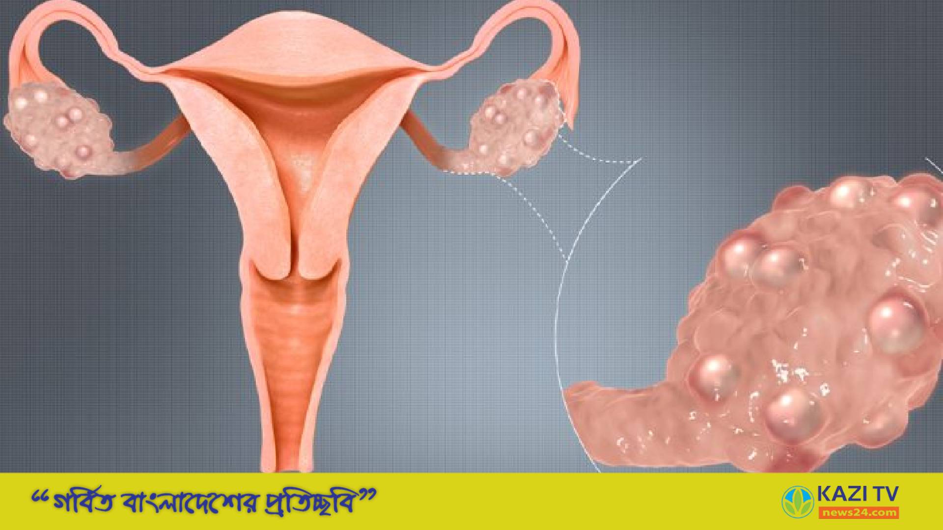 ওভারিয়ান সিস্ট কী? ওভারিয়ান সিস্ট কী কারণে হয়?