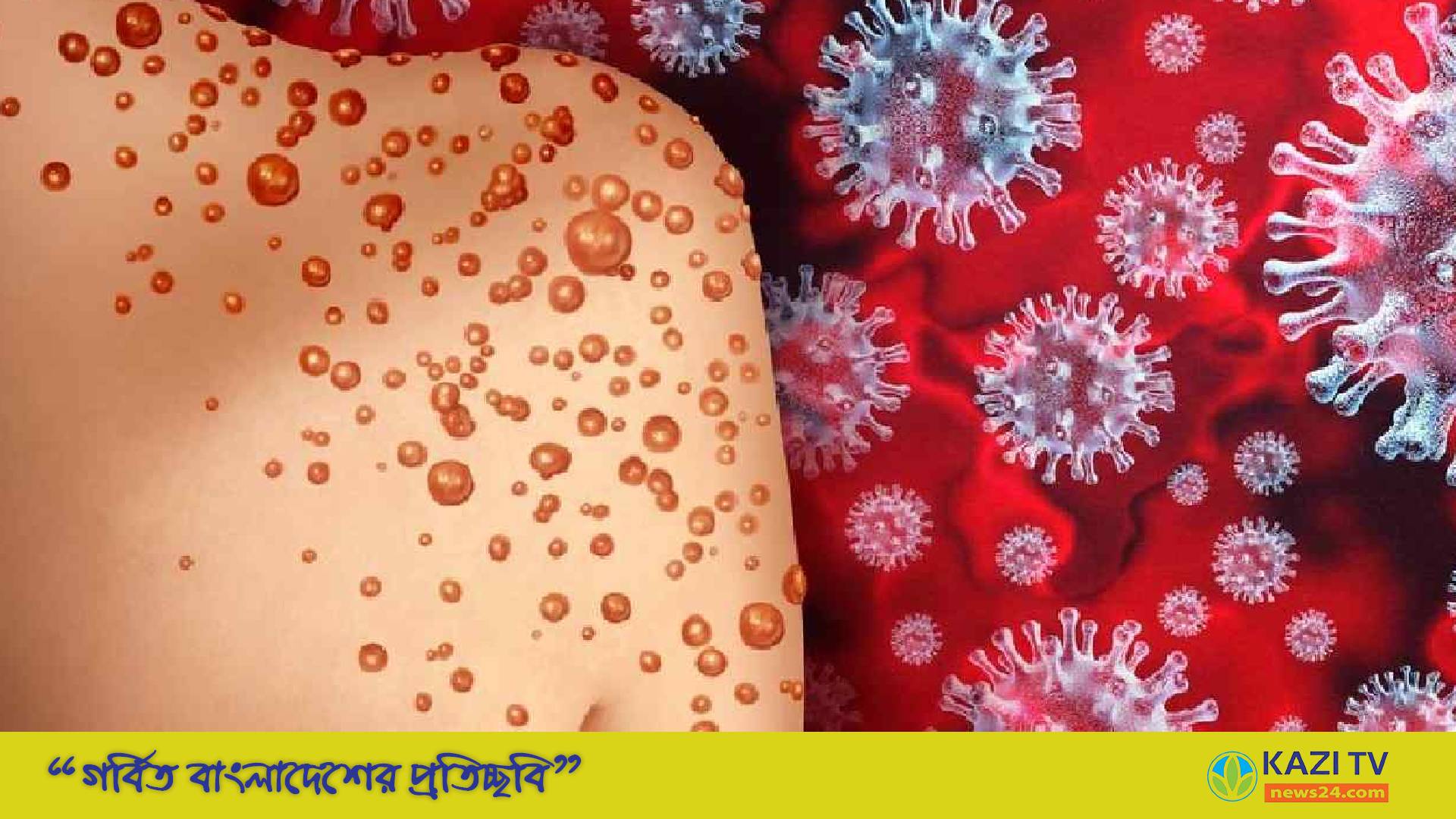 কানাডায় মাঙ্কিপক্স শনাক্ত