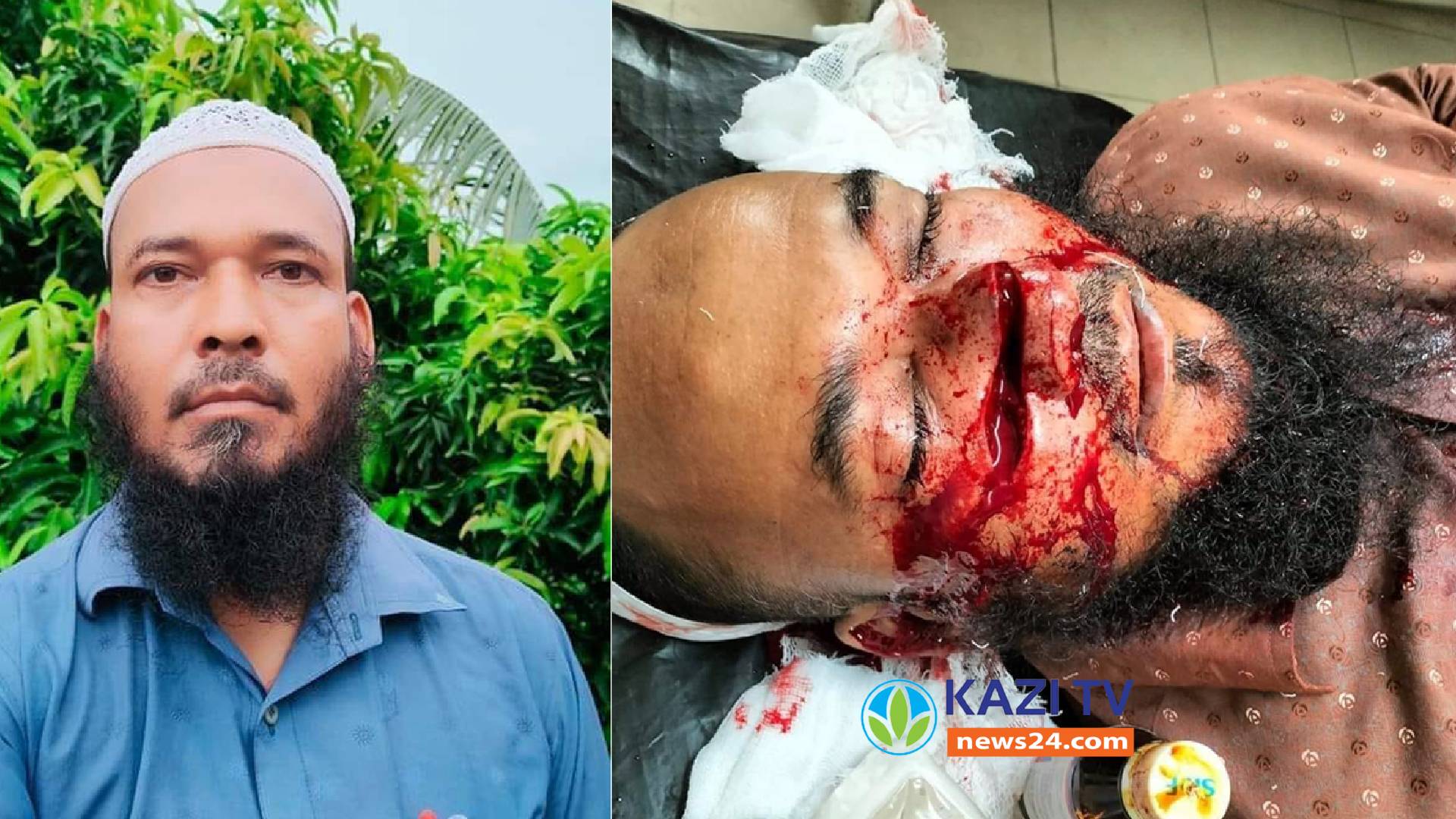 মতলব উত্তরে দুর্বৃত্তের আঘাতে মৎস্য ব্যবসায়ী আনোয়ার আহত